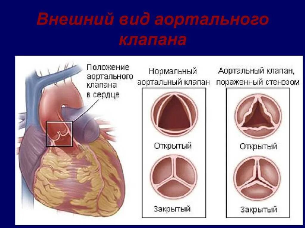 Аортальный стеноз что это такое. Пороки аортального клапана. Стеноз аортального клапана. Порок сердца стеноз аортального клапана. Стеноз двустворчатого аортального клапана.