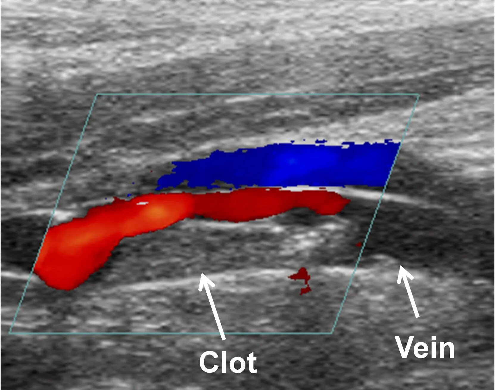 Тромбоз глубоких вен нижних конечностей на УЗИ. Ультразвуковая допплерография артерий нижних конечностей. Ультразвуковая допплерография вен нижних конечностей. Тромбоз артерия и вена