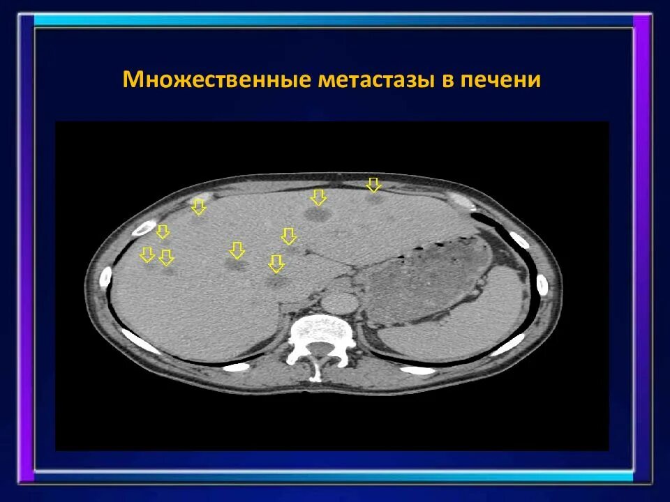 Продолжительность жизни при метастазах. Гиповаскулярные метастазы печени кт. Множественные метастазы в печени. Множественные метастазы печени на кт.