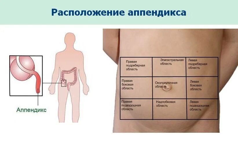 Где находится аппендицит. Где находится аппендикс. Аппендицит симптомы расположение.