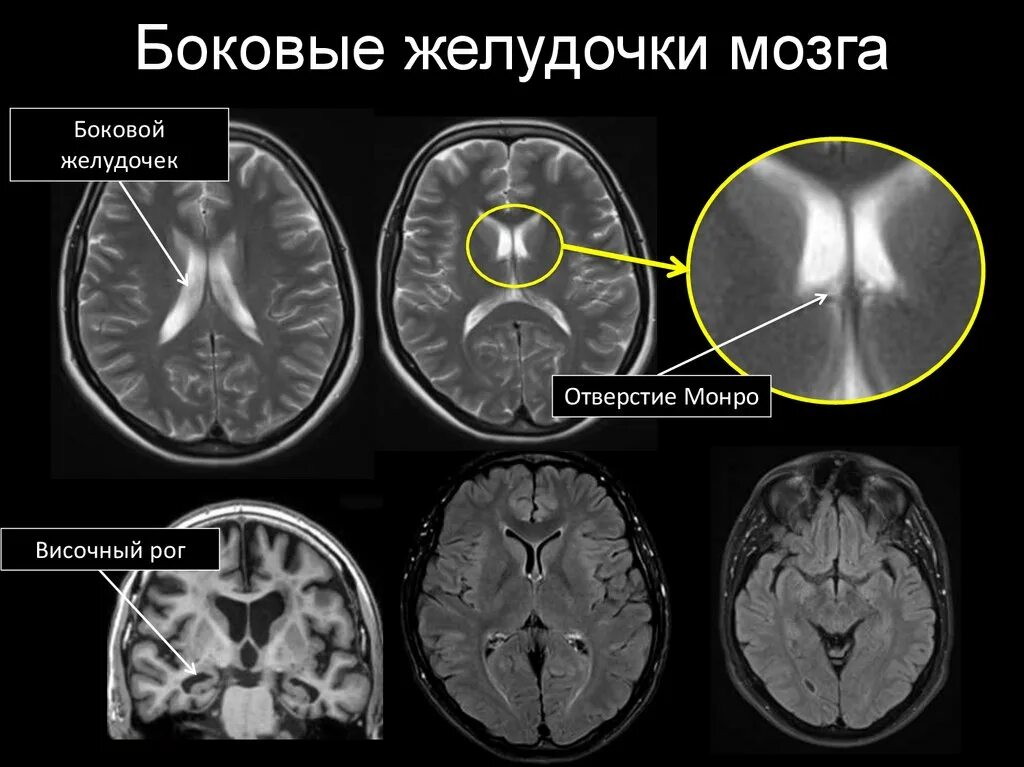 Расширение боковых рогов