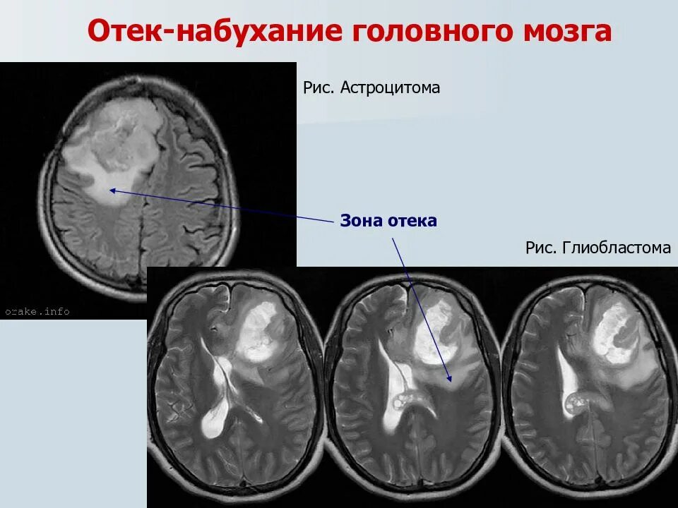 Отечность головного мозга. Отек мозга осложнения