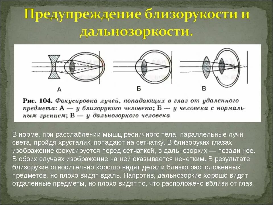 Дальнозоркость что делать. Близорукость ход лучей в глазе. Предупреждение близорукости и дальнозоркости. Близорукость и дальнозоркость. Профилактика близорукости и дальнозоркости.