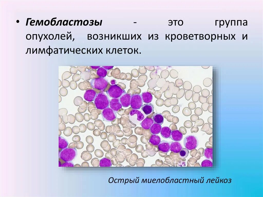 Гемобластозы. Гемобластозы лейкозы. Гемобластозы — заболевания кроветворной ткани:. Гемобластозы классификация.