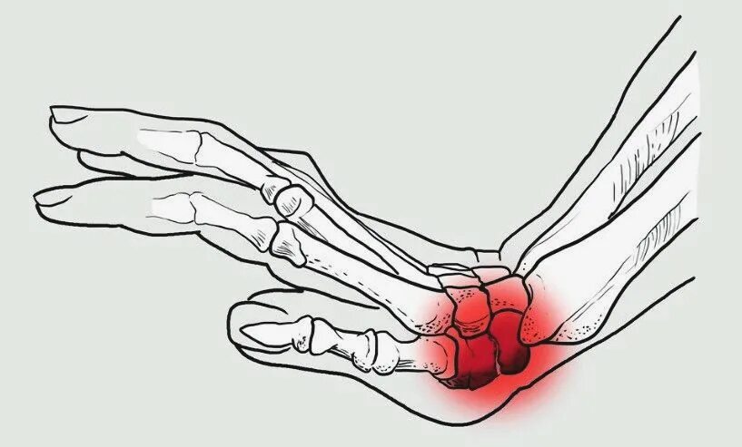 Сильные боли после перелома. Переломы кисти перелом ладьевидной кости. Перелом ладьевидной кости кисти симптомы. Перелом ладьевидной кости кисти запястье. Перелом костей кисти ладьевидная кость.