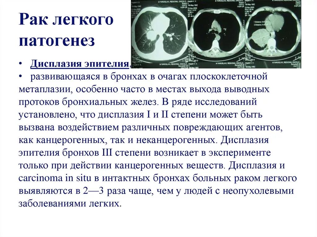 Лечение опухолей легкого. Опухоли органов дыхания. Диагностикарака лёгкого. Методы лечения опухолей лёгких. Диагноз опухоль легкого.