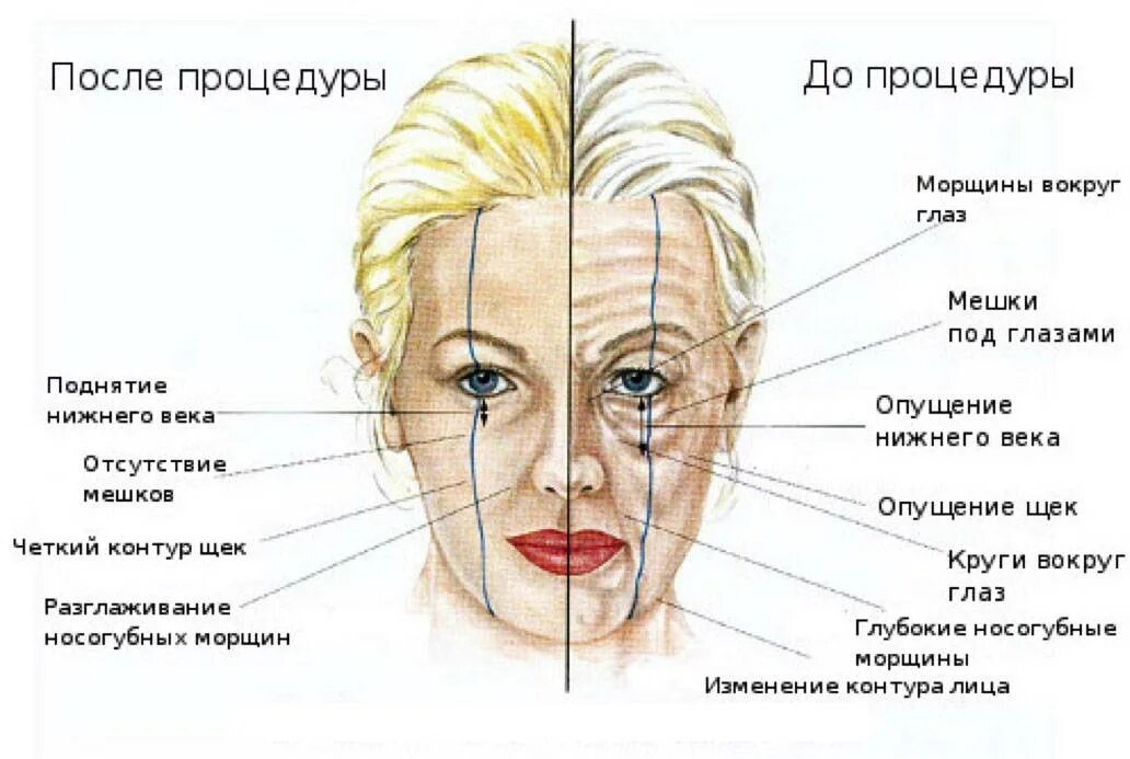 Колет бровь. Мышцы лица анатомия для косметологов для ботокса. Анатомия лица для косметологов ботокс. Схема мышц лица ботулотоксин. Анатомия мышц лица для косметолога ботокс.