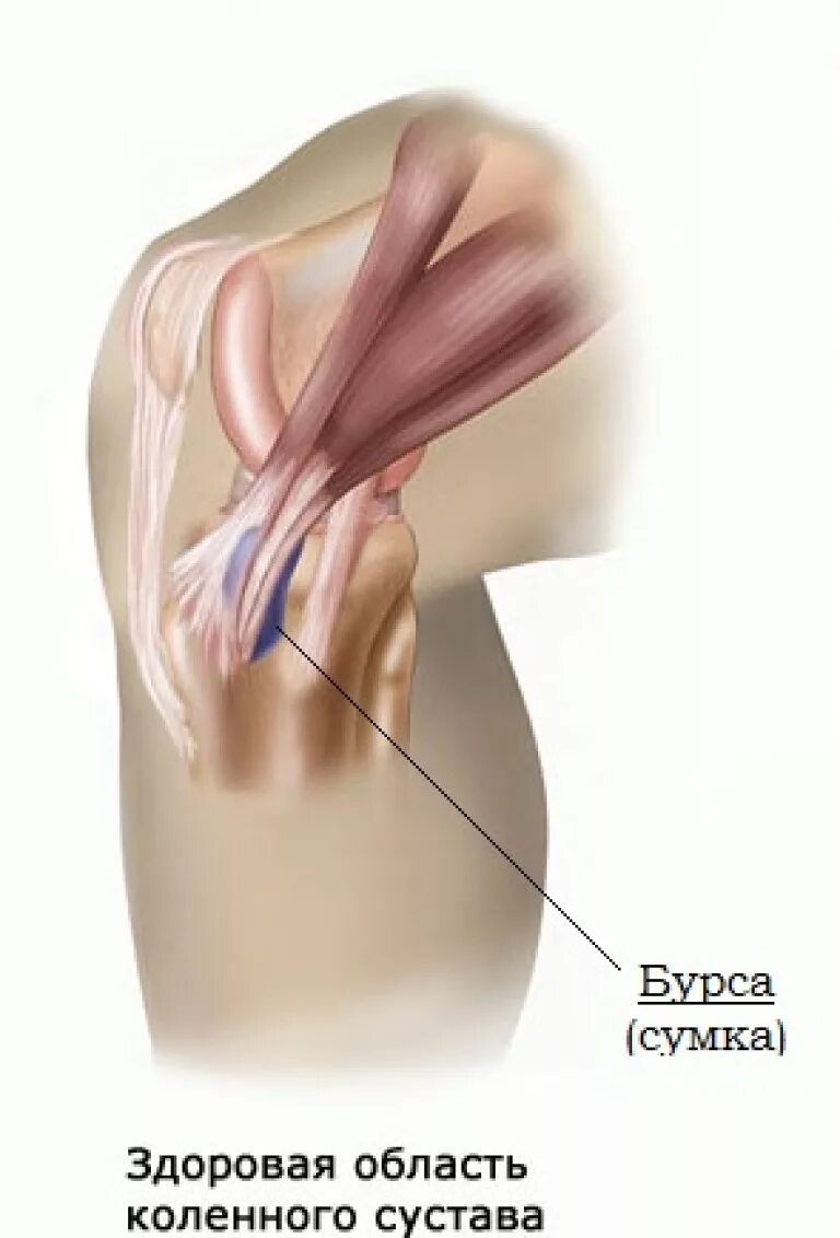 компресс при бурсите коленного сустава. бурсит колена коленного сустава. препателлярный бурсит. артропатия коленных суставов. повязка на локоть при бурсите.