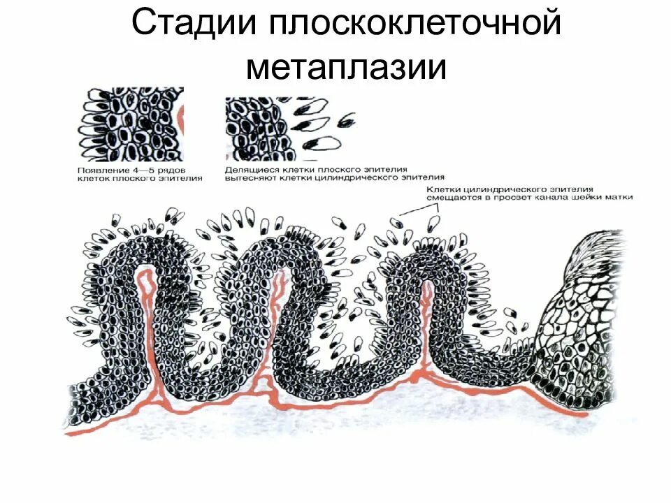 Изменения эпителия матки. Плоскоклеточная метаплазия гистология. Плоскоклеточная метаплазия шейки матки гистология. Метаплазия цервикального эпителия. Метаплазированный эпителий.