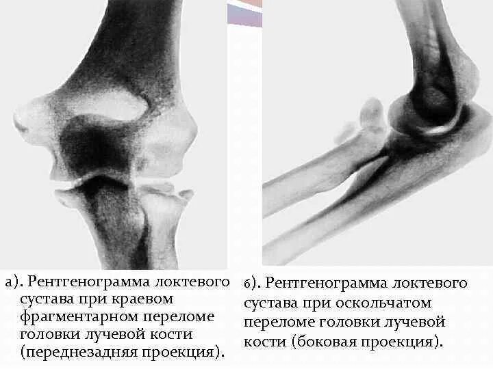 Оскольчатый перелом локтевого отростка. Перелом локтевого отростка локтевой кости. Лигаментоз локтевого сустава рентген. Оскольчатый перелом локтевого отростка рентген. Локтевого мыщелка