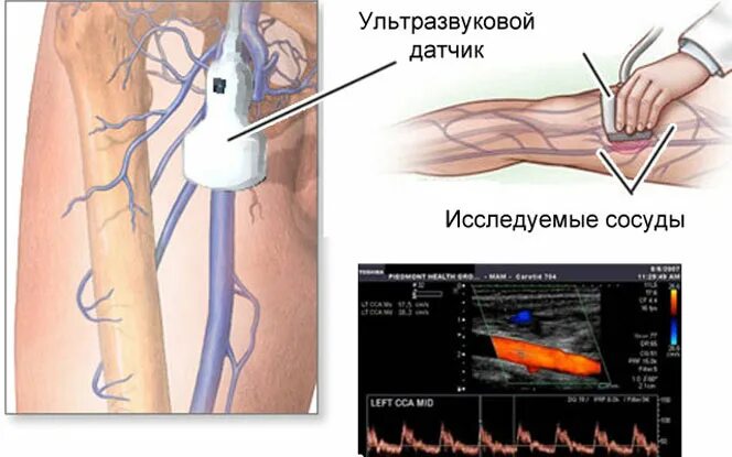 Доплер нижних конечностей. Ультразвуковая допплерография артерий нижних конечностей. УЗДГ – ультразвуковая допплерография сосудов. Допплерография вен и артерий нижних конечностей что это. Ультразвуковая допплерография вен нижних конечностей.