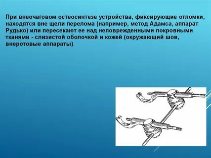 Остеосинтез при котором фиксирующий элемент