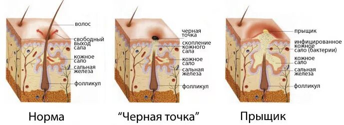 Виды прыщей на лице: тяжелые формы акне