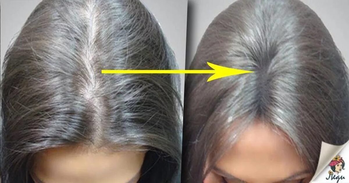 Нариа выпадения волос в день. Еорма выпадений волос в день. Норма волос. Норма выпадения волос в день. Нормальное количество волос.