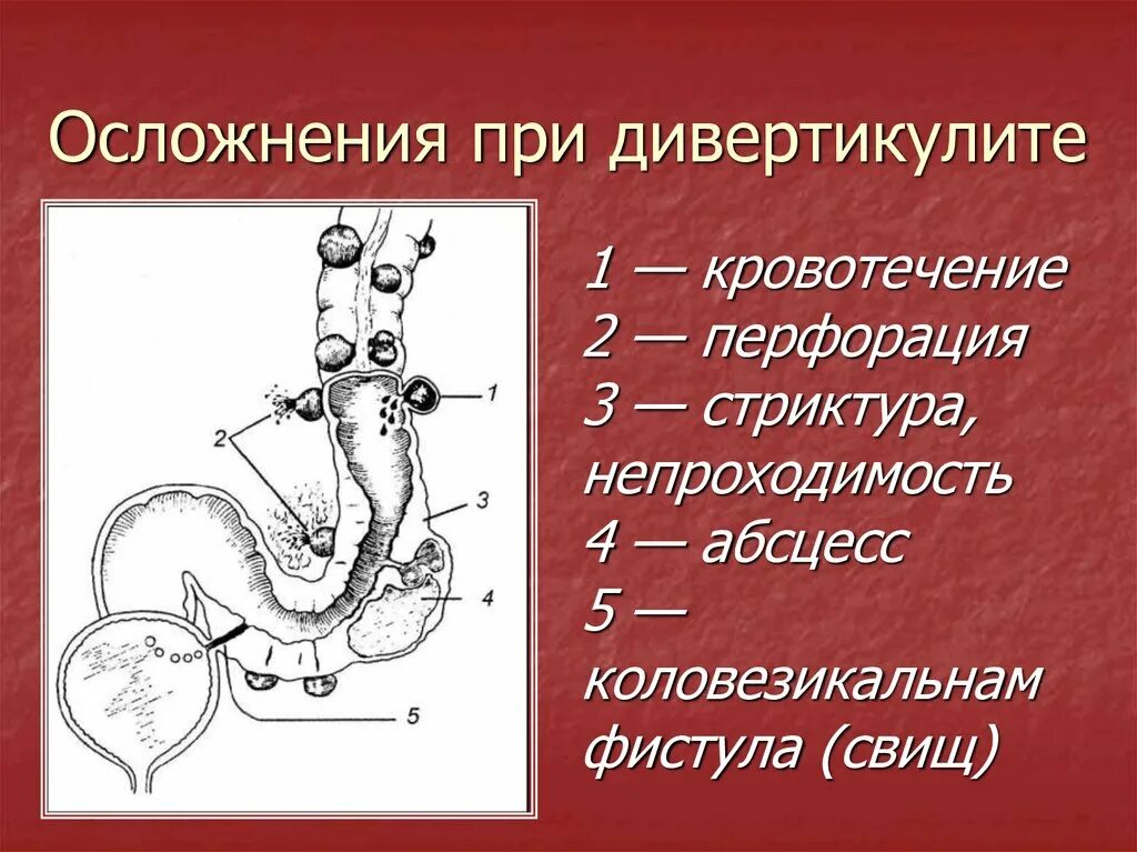 Осложнения дивертикулита. Осложнения дивертикулов ободочной кишки. Дивертикулит осложнения. Неотложная хирургия ободочной кишки. Дивертикул осложнения