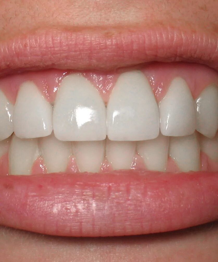 Идеальные зубы. Идеально ровные зубы. Красивая форма зубов.