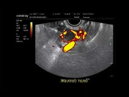 Доминантная фолликула в яичнике что это