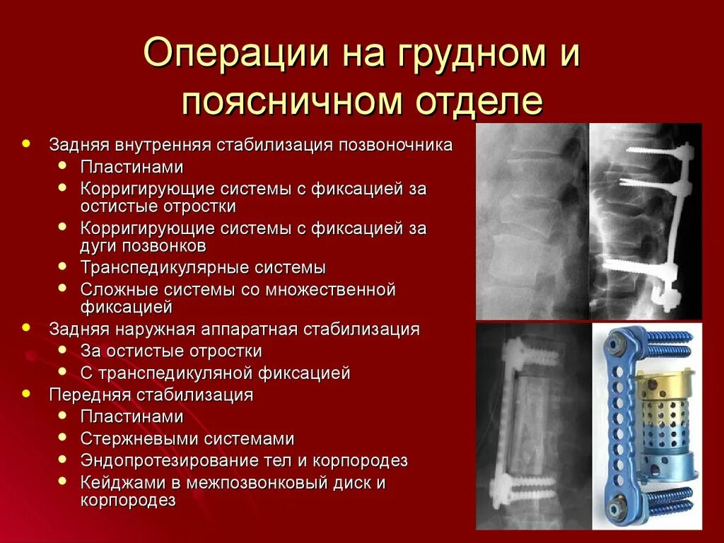 Операция на грудном отделе позвоночника