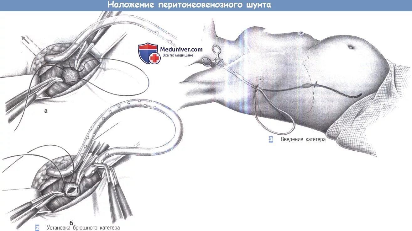 Самая самая шунт. Абдоминальный катетер шунта. Вентрикулоперитонеальное шунтирование у собак.