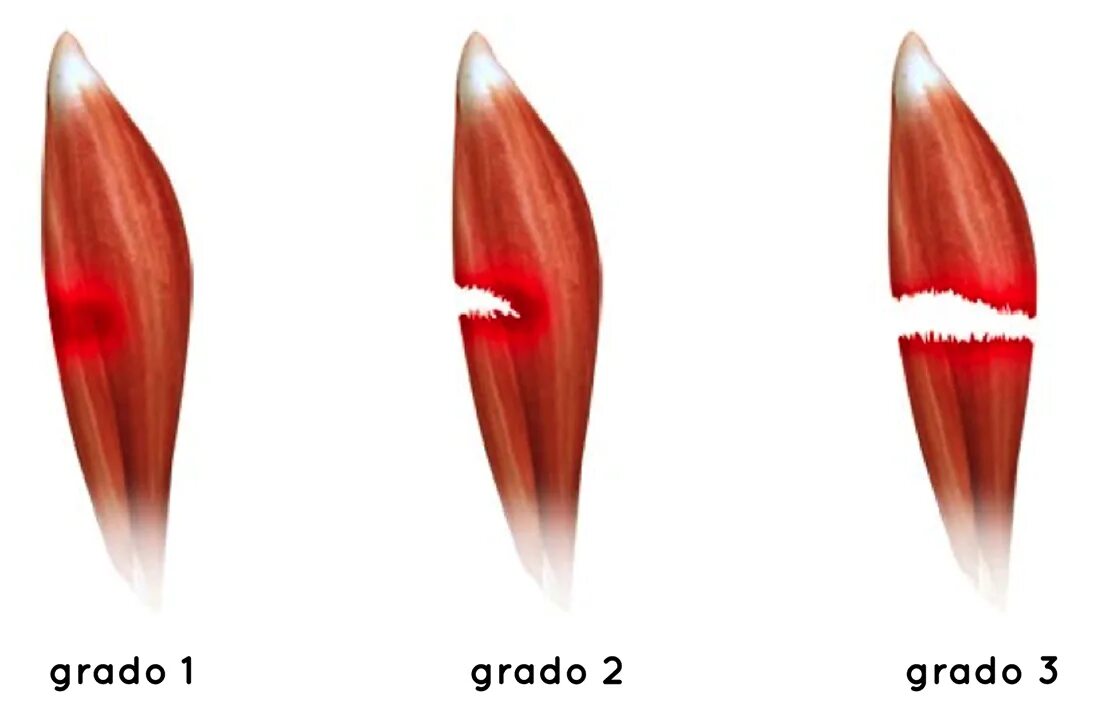 Разрыв мышц признаки. Степени растяжения мышц. Степени повреждения мышц.