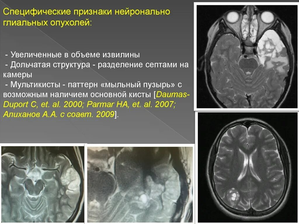 Глиальная опухоль головного