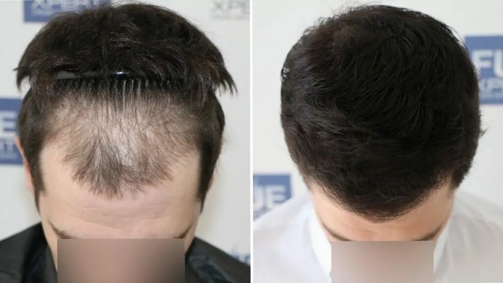 Соч что это. 2500 Hair transplant. Мезотерапия волос мужчин. Прически после пересадки волос.