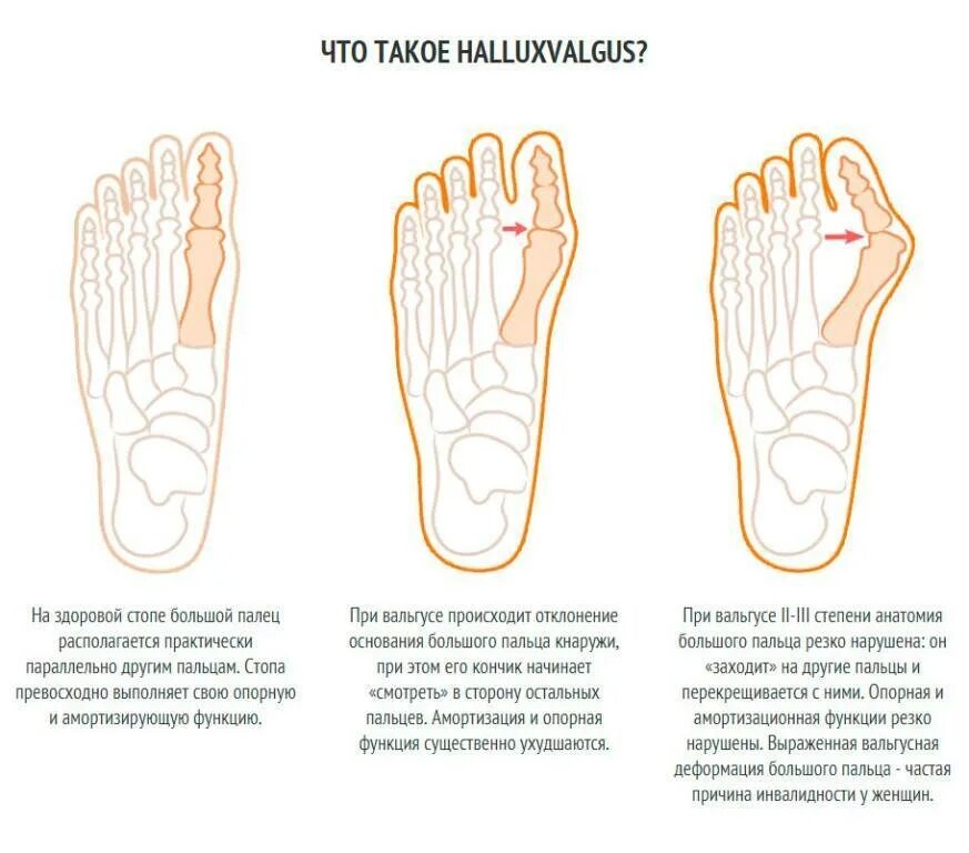 Пятки внутрь. Вальгусная деформация стопы упражнения для коррекции. Лечебная физкультура при халюс вальгус. Вальгусная деформация большого пальца плоскостопия.