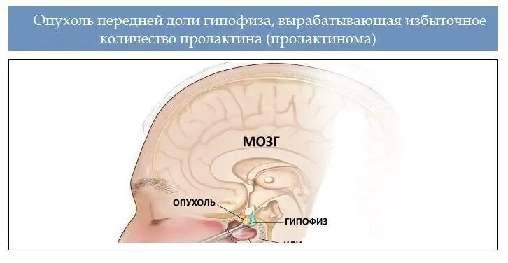 Гипофиза симптомы у женщин лечение прогноз. Опухоль микроаденома гипофиза. пролактин продуцирующие опухоли гипофиза. пролактиновая аденома гипофиза. аденома гипофиза головного мозга что это такое.