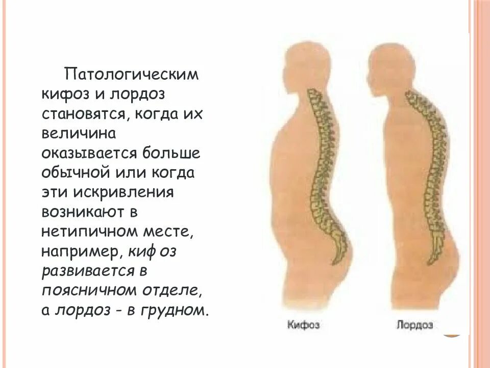 Изгибы позвоночника. 1 лордоз. Лордоз кифоз сколиоз у детей. Лордоз шейного отдела отдела. 1 лордоз.
