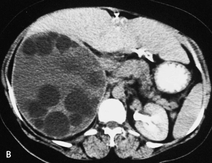 Киста печени мрт. Эхинококковая киста печени кт. Альвеолярный эхинококкоз печени кт.