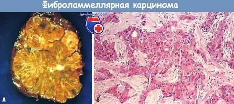 Карцинома отзывы
