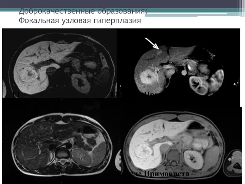 Фокальная гиперплазия печени. Фокальная нодулярная гиперплазия печени на кт. Узловая гиперплазия печени кт. Фокальная Узловая гиперплазия печени на мрт. Фокальная Узловая гиперплазия печени кт.