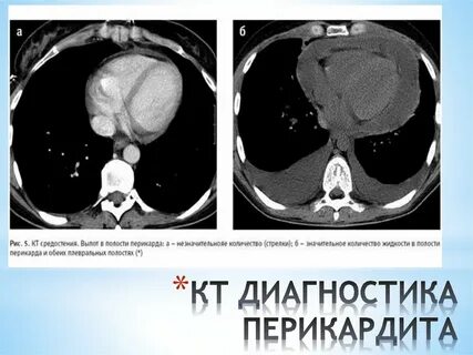 Выпот в перикарде