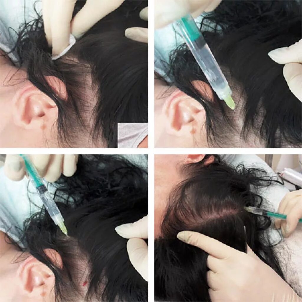 Инъекции головы. Мезотерапия для волос. Плазмолифтинг головы для волос. Плазмолифтинг кожи головы. Мезотерапия кожи головы.