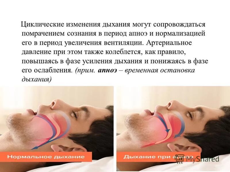 апноэ кишлак осу