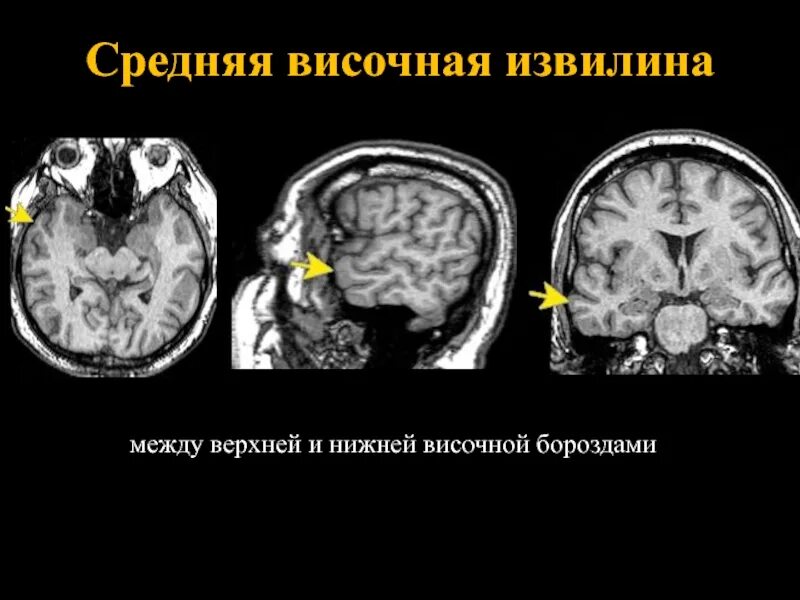 Поперечные височные извилины гешля. Верхняя лобная извилина кт. Верхняя лобная извилина. Головной мозг анатомия человека борозды и извилины. Средняя височная извилина мрт.