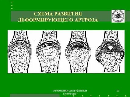 Дегенеративное изменение сустава это
