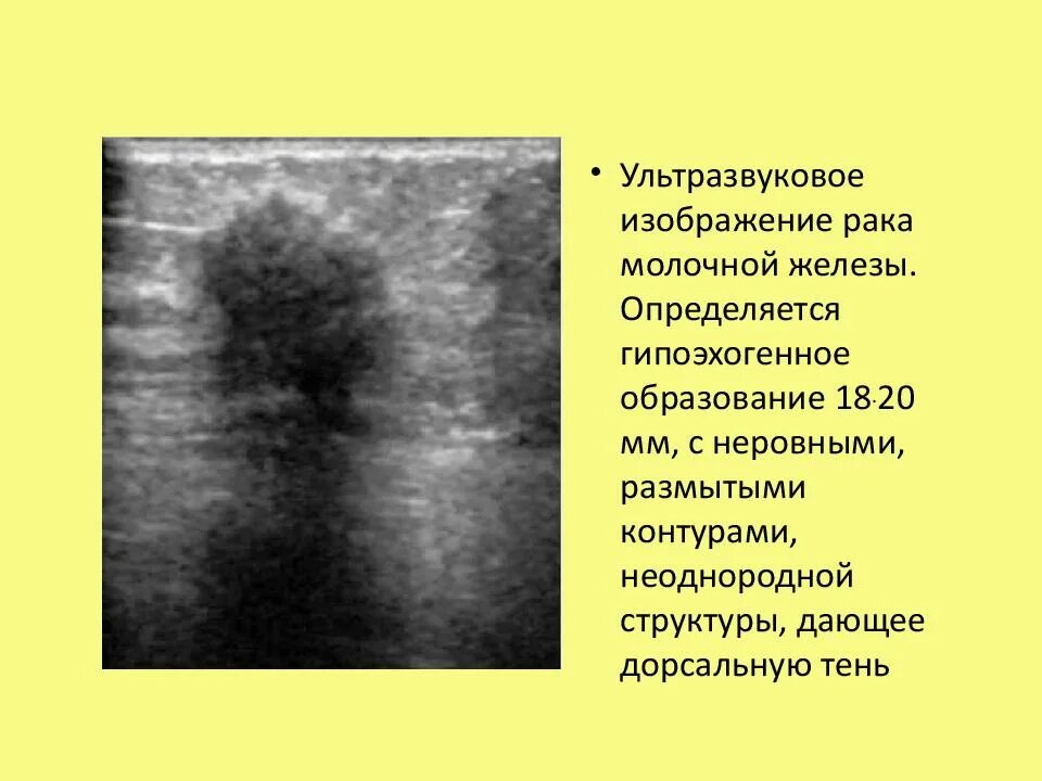 Образование без акустической тени. Образования молочной железы на УЗИ. Гипоэхогенные образования в молочной железе. Гипоэхогенное образование с нечеткими контурами. Гипоэхогенное образование с неровными нечеткими контурами.