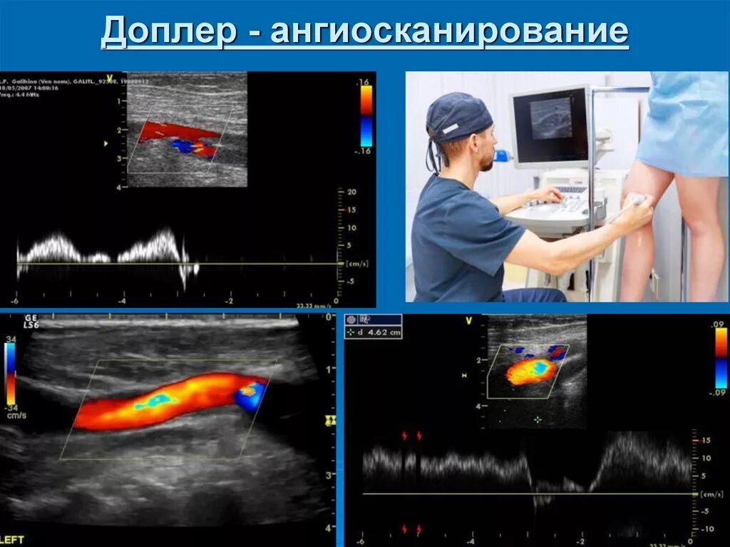 Ангиосканирование нижних конечностей. Ультразвуковое ангиосканирование и ультразвуковая допплерография. ультразвуковое дуплексное ангиосканирование. тромбофлебит ультразвуковое дуплексное ангиосканирование.. ультразвуковое ангиосканирование артерии нижних конечностей.