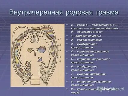 Внутричерепная травма