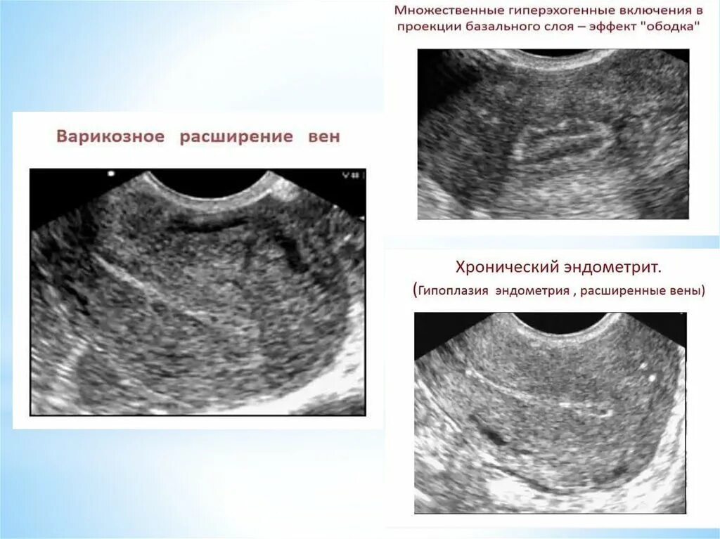 Острый послеродовой эндометрит УЗИ. Эндометрия матки УЗИ гиперплазия эндометрия. Гиперплазия эндометрия эндометрит. Структурные изменения матки