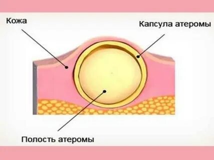 Доброкачественное новообразование жировой ткани кожи
