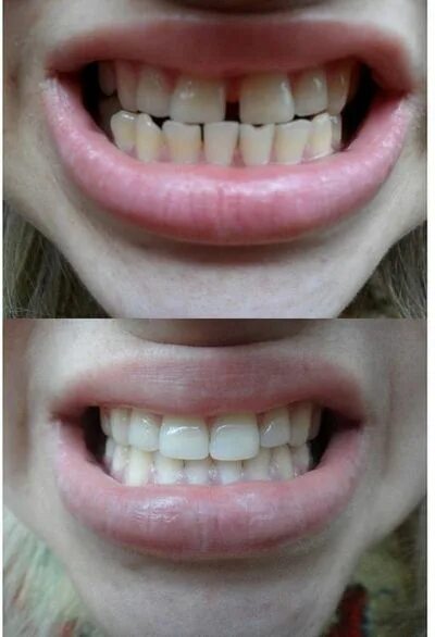 огромная щель между зубами. как убрать щель между передними. диастема паради. диастема зубов щербинка. красивые зубы.
