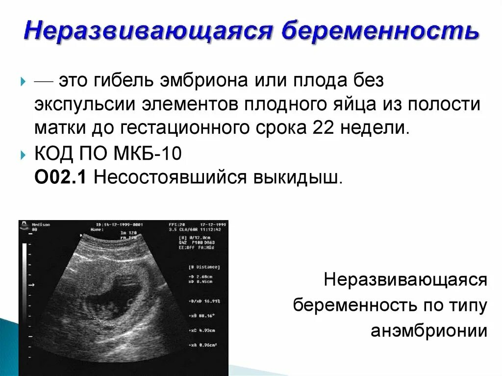Неразвивающаяся беременность код. УЗИ признаки неразвивающейся беременности. Критерии замершей беременности. Неразвивающаяся беременность симптомы. Симптомы замершей беременности на ранних.
