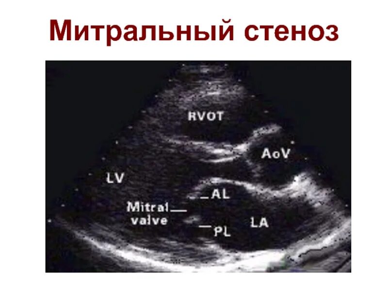 Стеноз митрального клапана на ЭХОКГ. Стеноз митрального клапана на УЗИ. Aortal stenoz exokardiographia. Митральный стеноз критерии ЭХОКГ. Митральный стеноз признаки