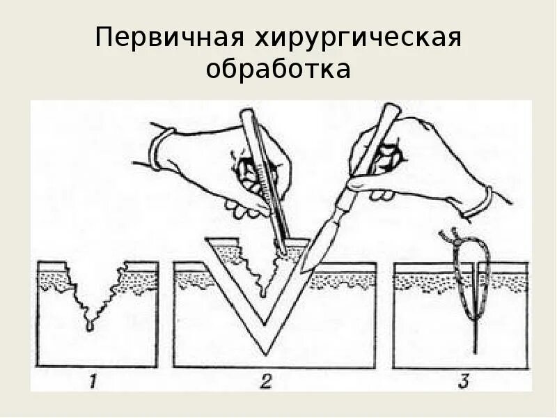 Первичная хирургическая обработка это. Первичная хирургическая обработка. Схема Пхо при термических поражениях. Первичная хирургическая обработка ожогов. Пхо классификация.