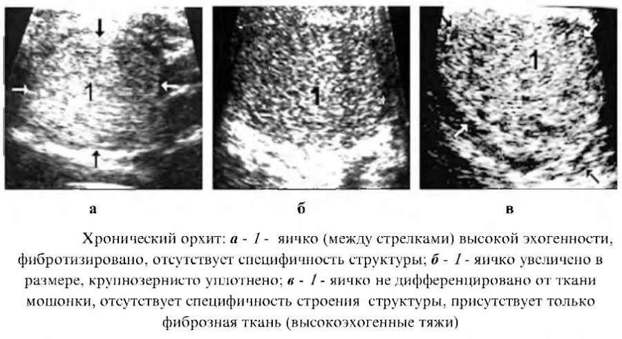 Орхит симптомы. Хронический орхит узи признаки.