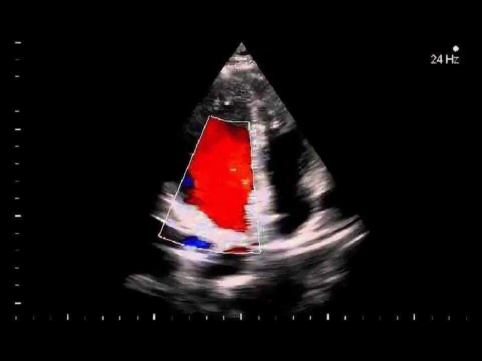 Инфаркт миокарда узи эхо-кг. Аномалии расположения аорты. Эхокг при миокардите. Эхокардиография (ультразвуковое исследование сердца). Эхо кс.
