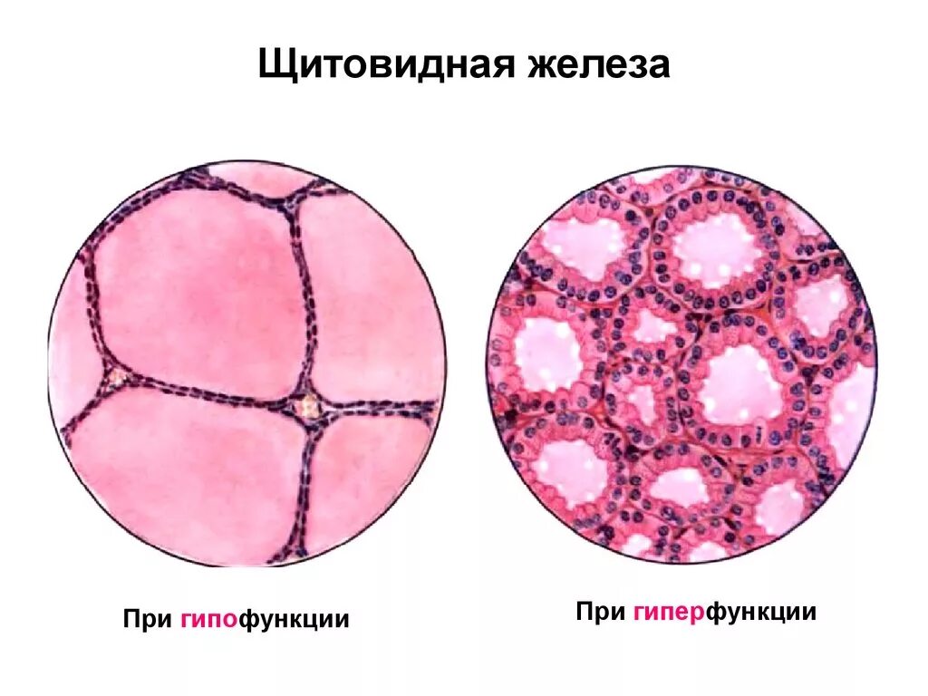 Гипофункция щитовидной железы гистология. Гиперфункция щитовидной железы гистология. Тироциты щитовидной железы гистология. Строение щитовидной железы гистология препарат.