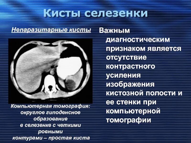 Гиподенсивное образование в печени. Паразитарная киста селезенки. Очаговое поражение селезенки кт. Паразитарная киста селезенки на кт.